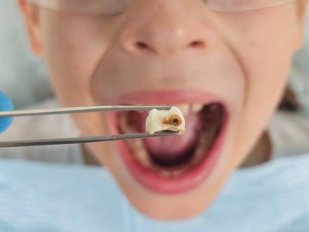 Best Emergency Treatment for Oral Infections in Somersworth, NH